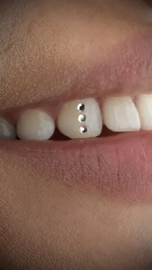 Front Teeth Dental Gems