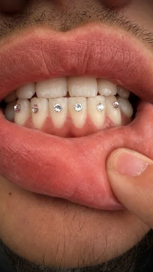 Gemstone Teeth Microrealism